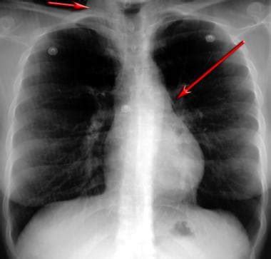 asthma on xray|Asthma Imaging and Diagnosis: Practice Essentials, .